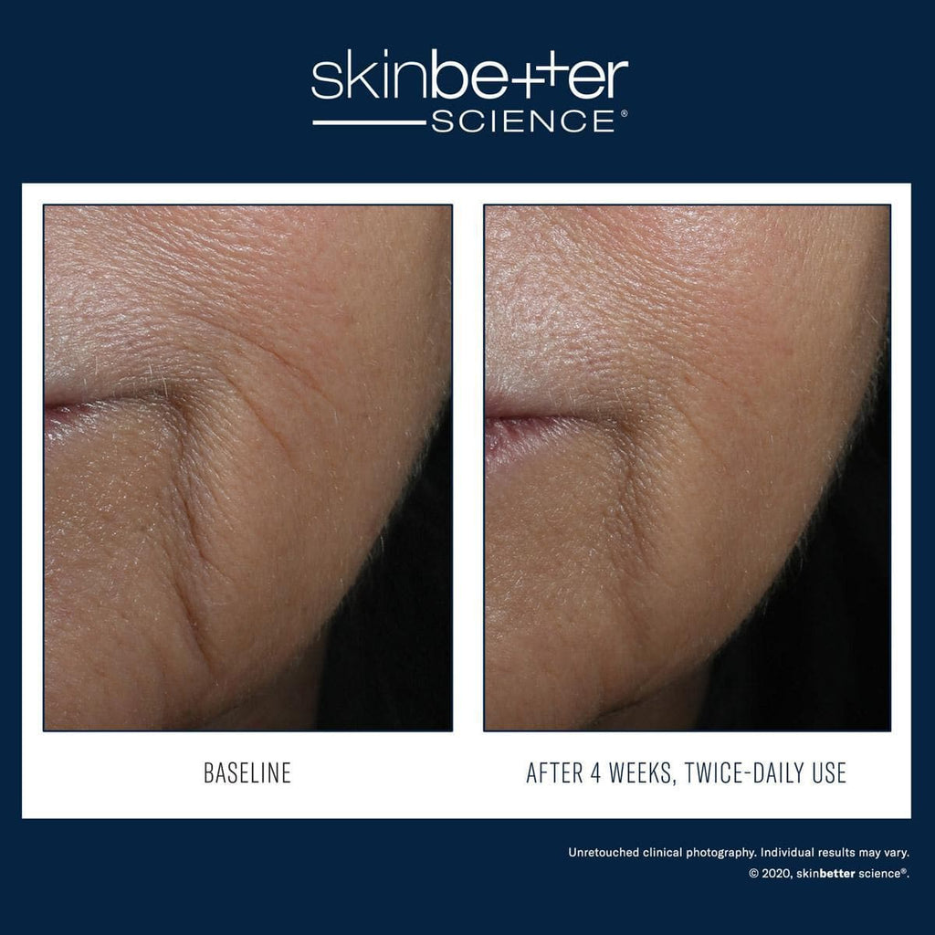 Skinbetter Science - Interfuse Intensive Treatment Lines - Monarch MD Medical Aesthetics by Double Board Certified Facial Plastic Surgeon Dr. Eli Akbari MD, FRCSC